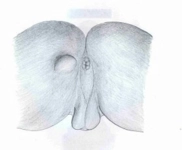 Makatta İltihap Belirtileri ve Tedavisi Makatta İltihap Belirtileri ve Tedavisi