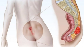 Kuyruk Sokumunda İltihap