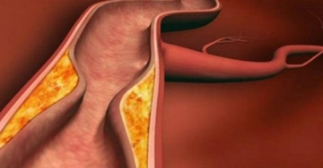 İltihap Belirtileri ve Tedavisi İltihap Belirtileri ve Tedavisi