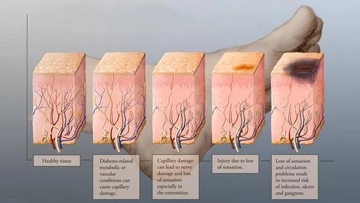 Sinir Ucu İltihabı Belirtileri ve Tedavisi Sinir Ucu İltihabı Belirtileri ve Tedavisi